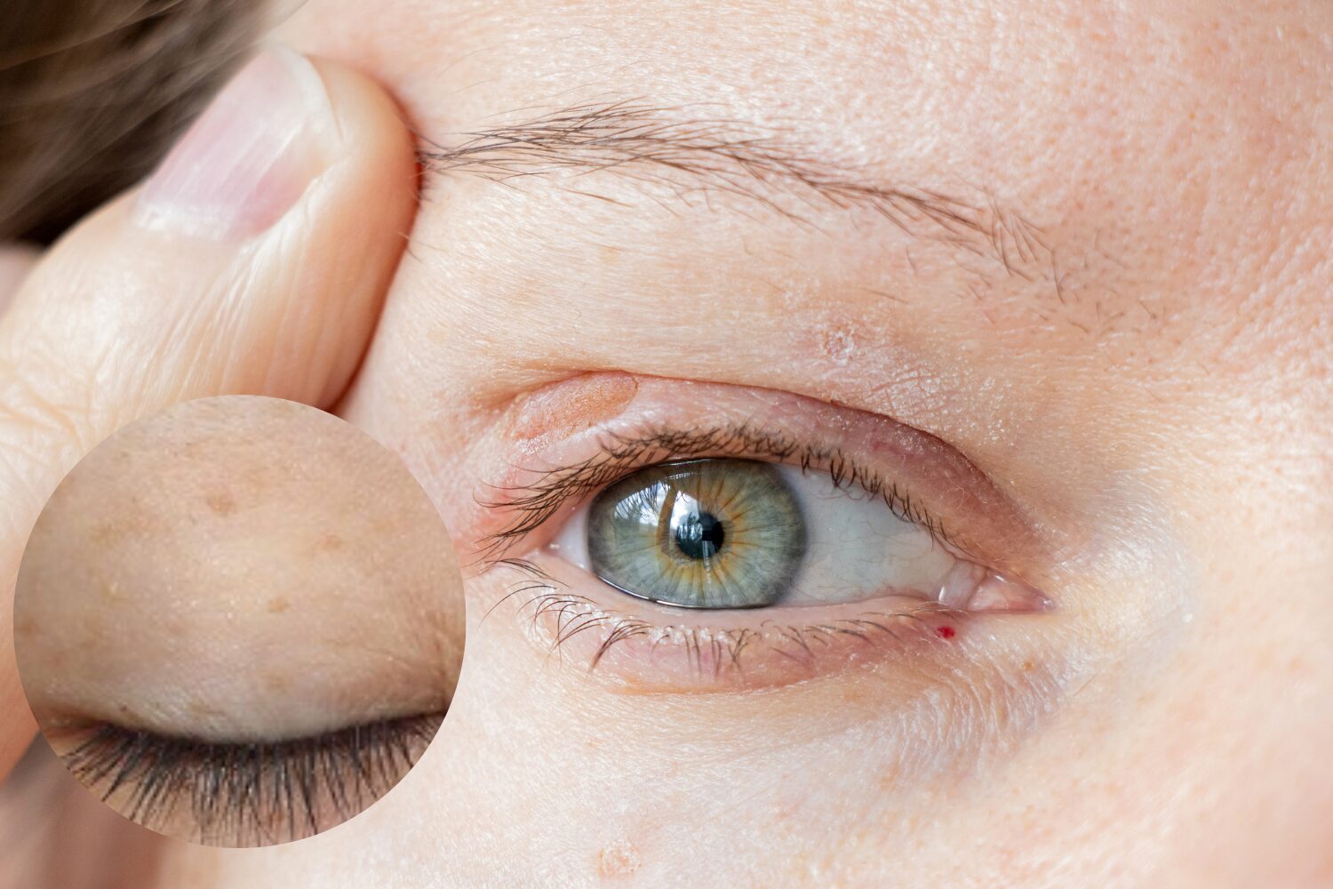 まぶたのシミ取りはどうする？原因・治療法・注意点まで詳しく解説