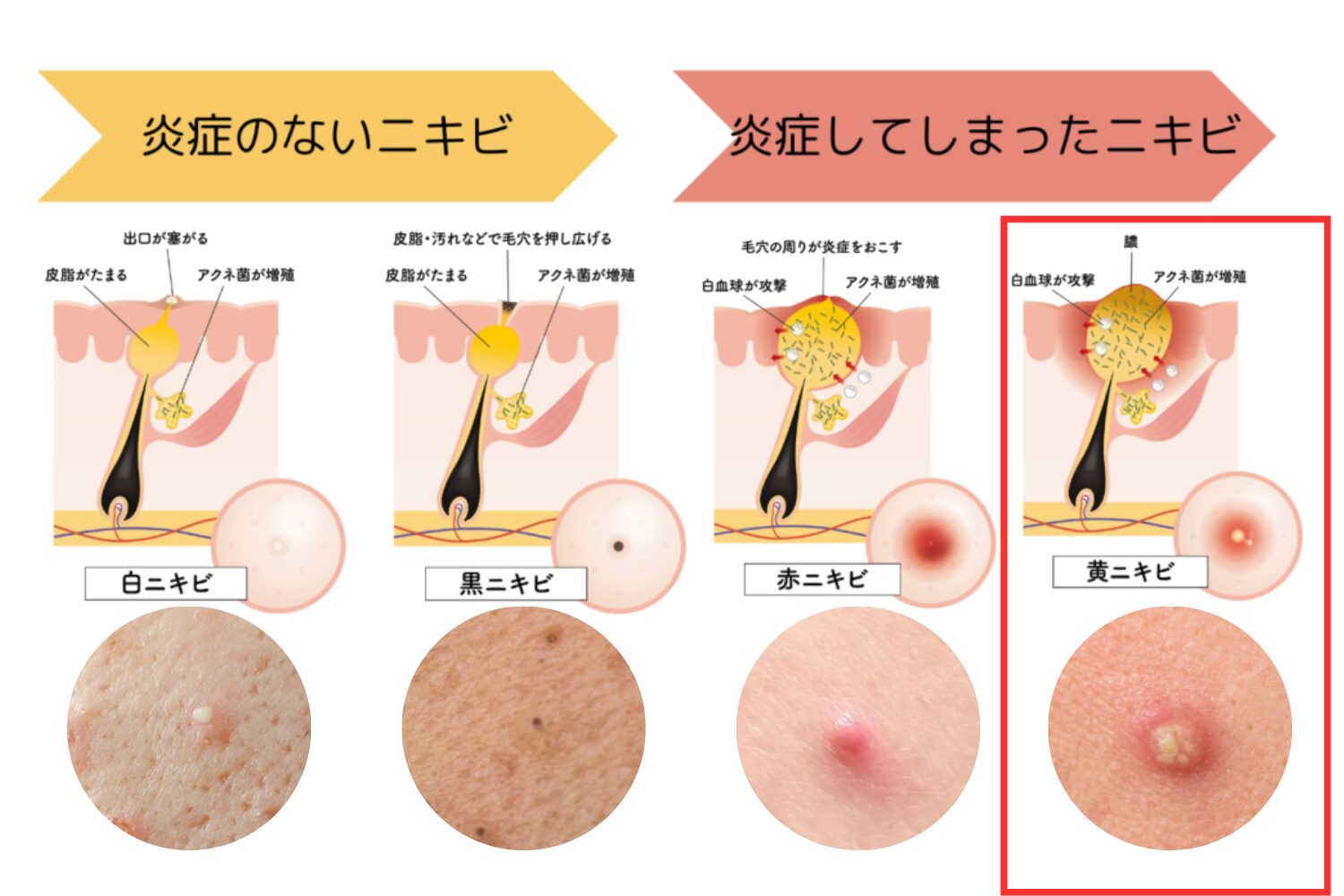 黄色ニキビの原因と治し方、悪化を防ぐ正しいケア方法を解説 - ハートライフクリニック（静岡県浜松市の美容皮膚科・美容外科）