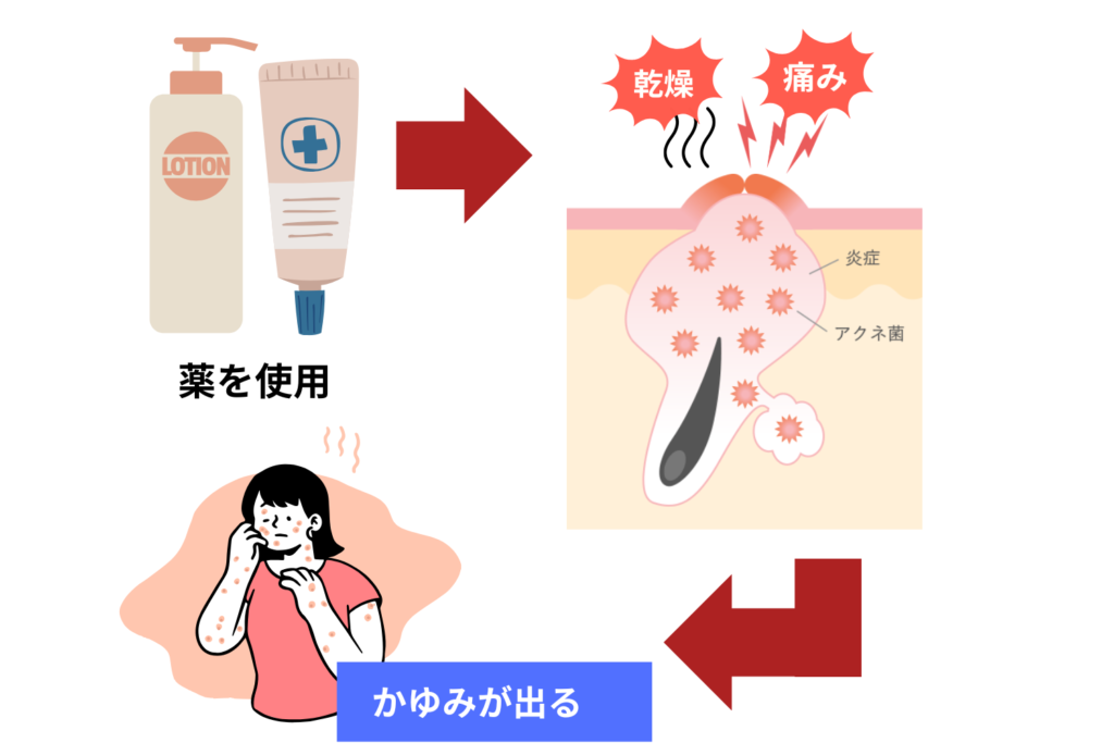 治療薬による乾燥・刺激でかゆみが出ることもある