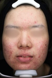 ニキビビフォー