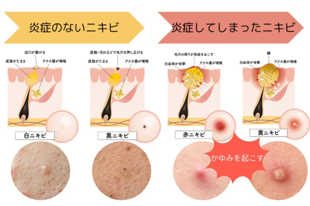 かゆいニキビの主な原因と発生メカニズム