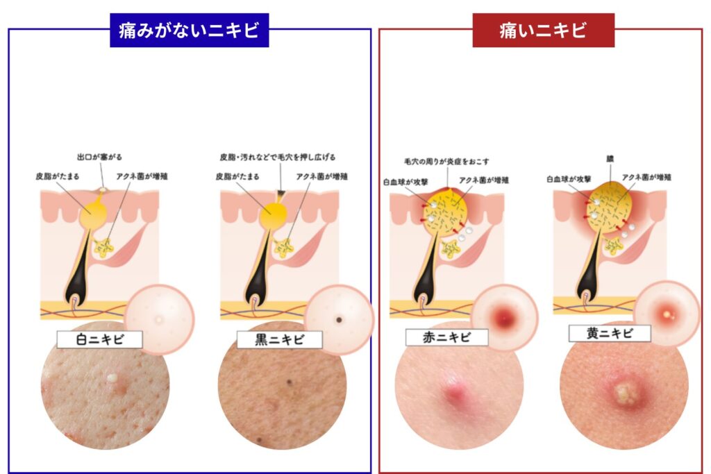 痛いニキビの種類と見分け方