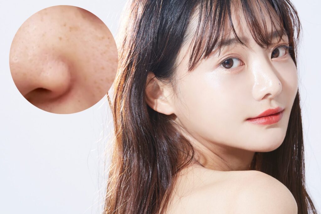 20代のシミ取り完全ガイド｜原因・種類・治療と予防法を解説