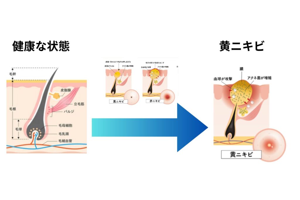 皮脂分泌と炎症反応