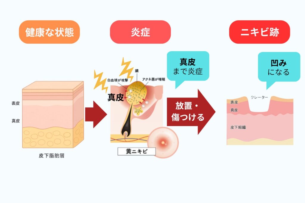 炎症による組織破壊