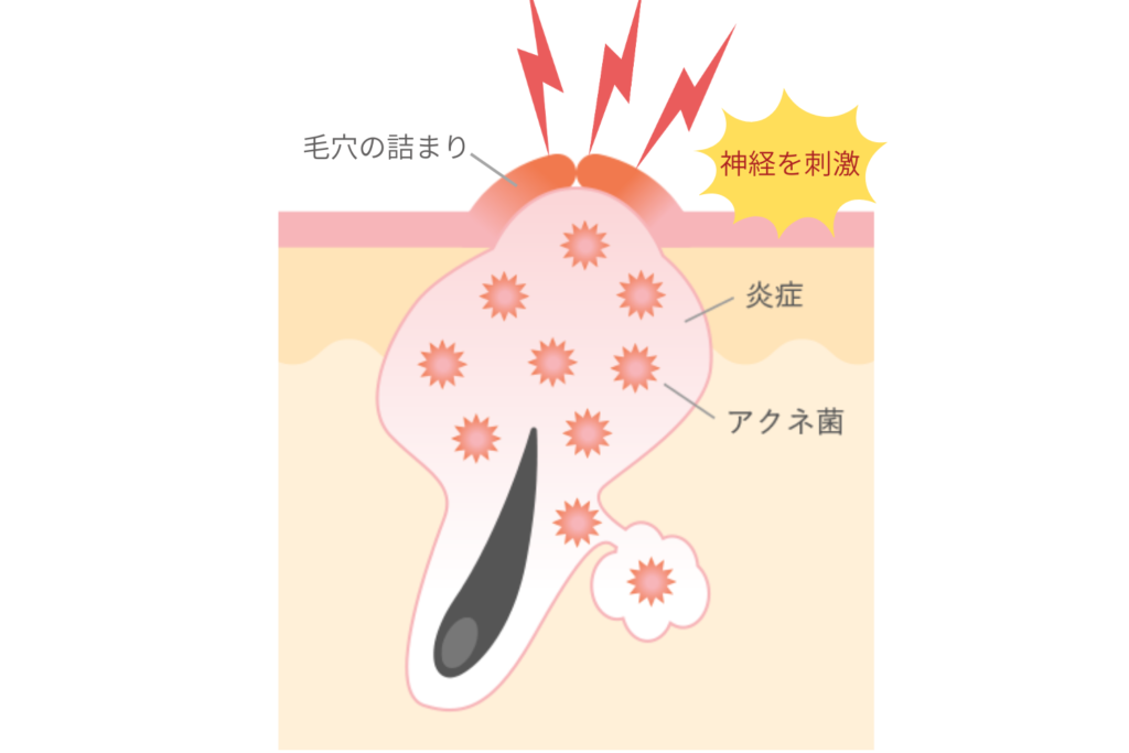 痛みが出るのは炎症が進んでいる証拠