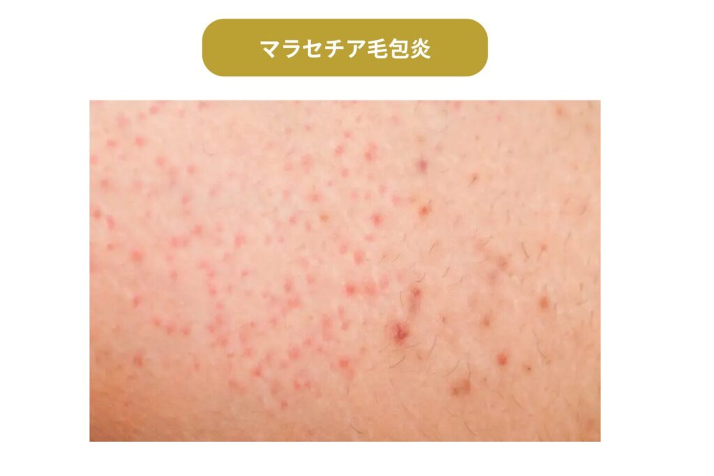 マラセチア毛包炎