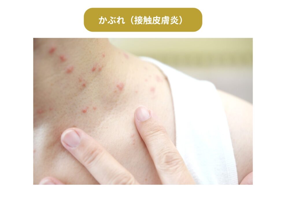 かぶれ（接触皮膚炎）