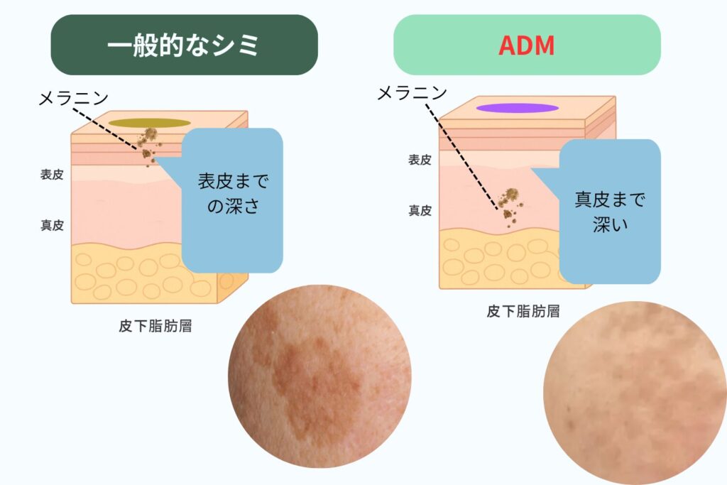 ADMと一般的なシミの違いを理解する