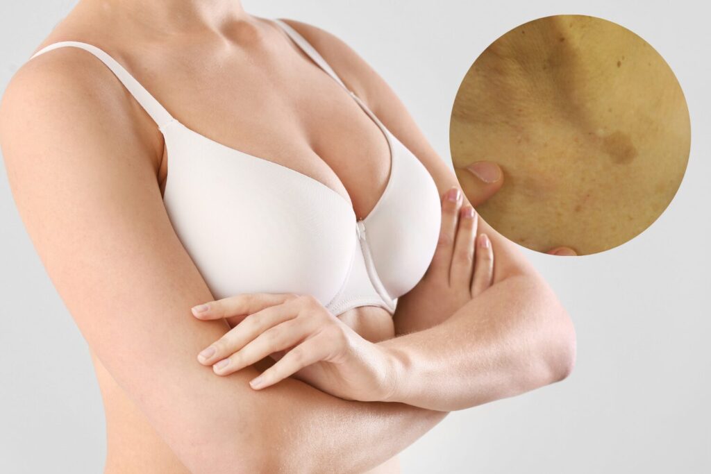 胸のシミ原因と正しい対策|種類別の見極め方と治療法ガイド