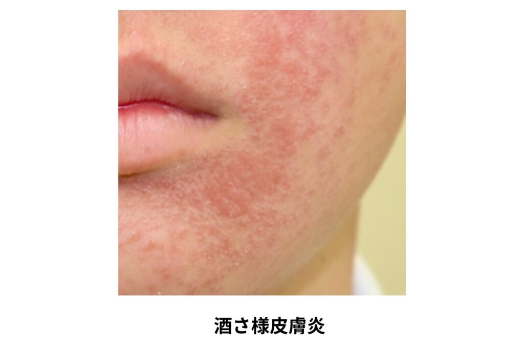 酒さ様皮膚炎