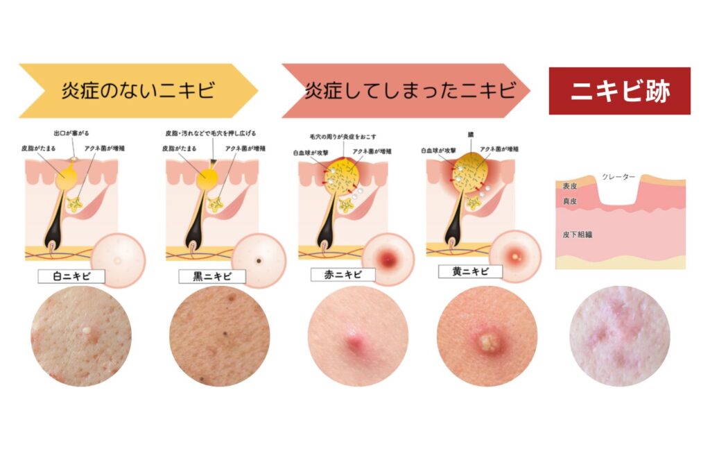 ニキビ跡（クレーター）ができる主な原因