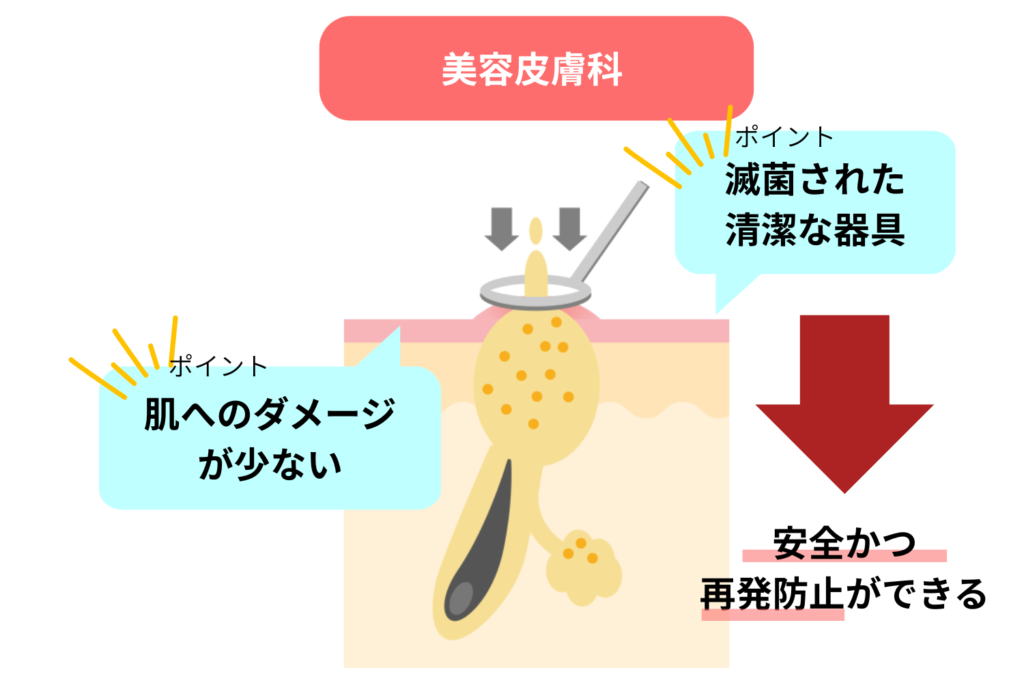 美容皮膚科｜安全にニキビの芯を取り除ける