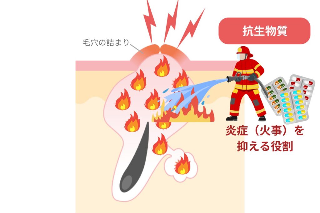 炎症型ニキビへの効果