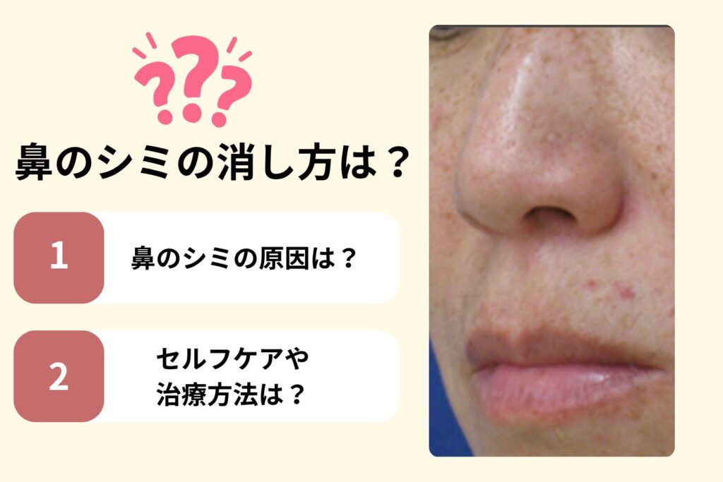 鼻のシミは原因特定で薄くできる|種類と消し方・最短治療法
