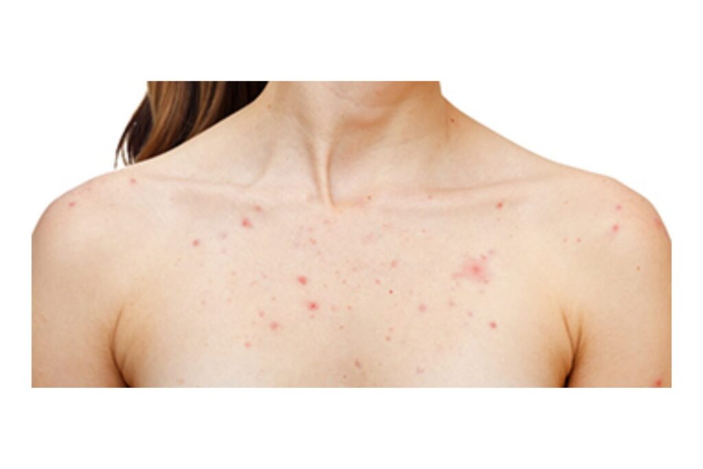 炎症後色素沈着