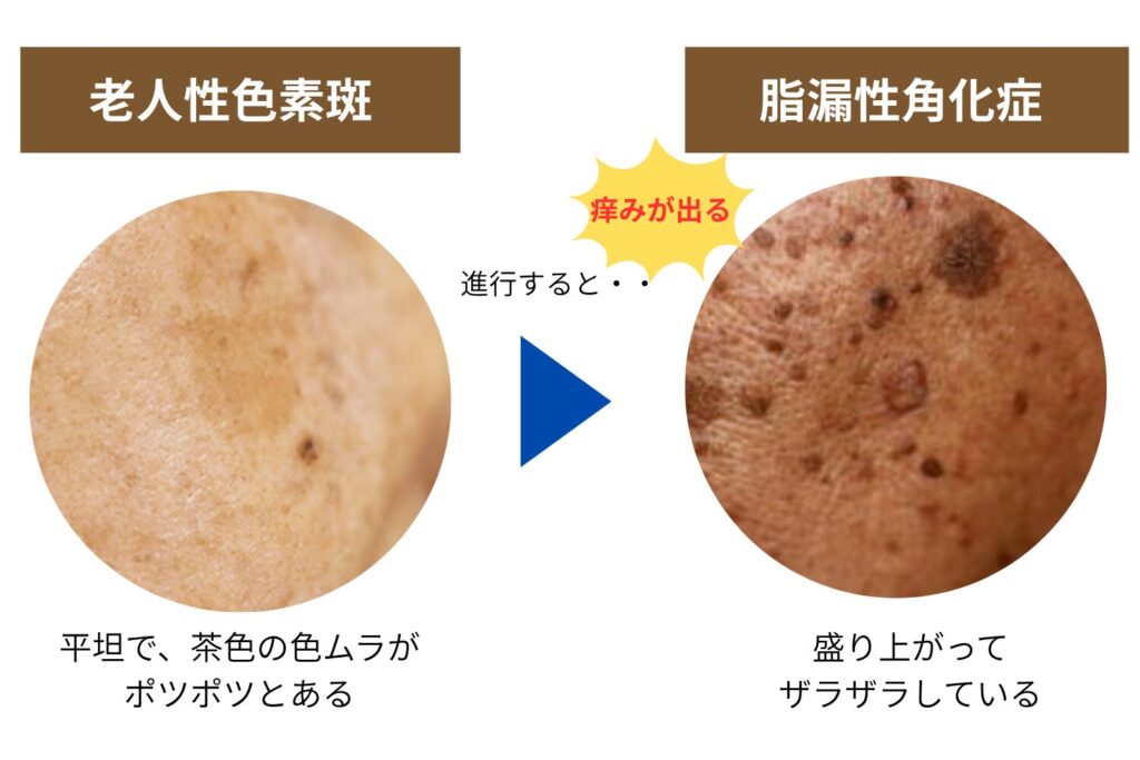 シミの種類と見分け方