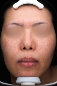 ニキビアフター