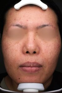 ニキビビフォー