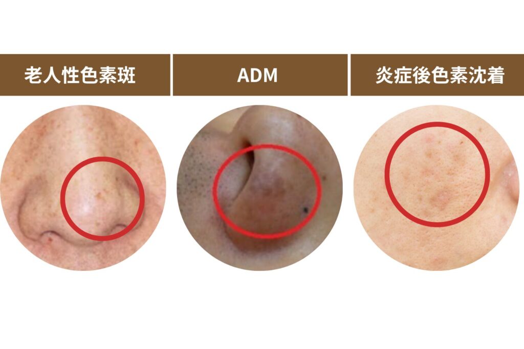シミの種類を正しく判断