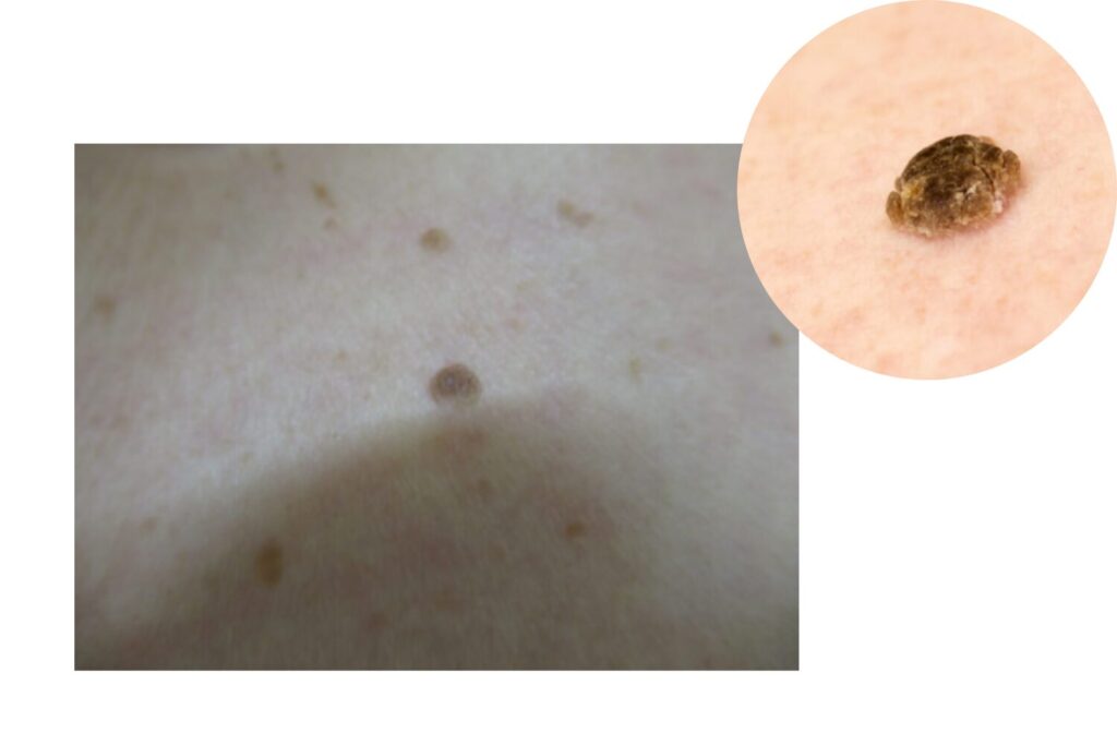 脂漏性角化症といぼの特徴