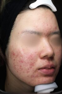 ニキビ
