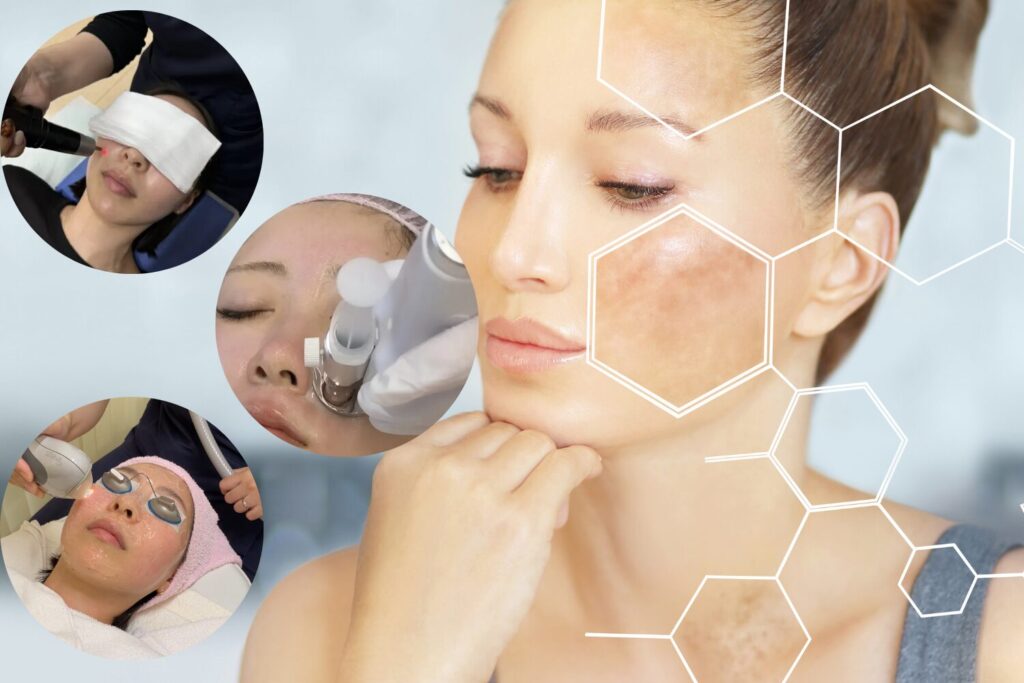 シミ取りの正しい方法|原因・治療・予防を徹底解説