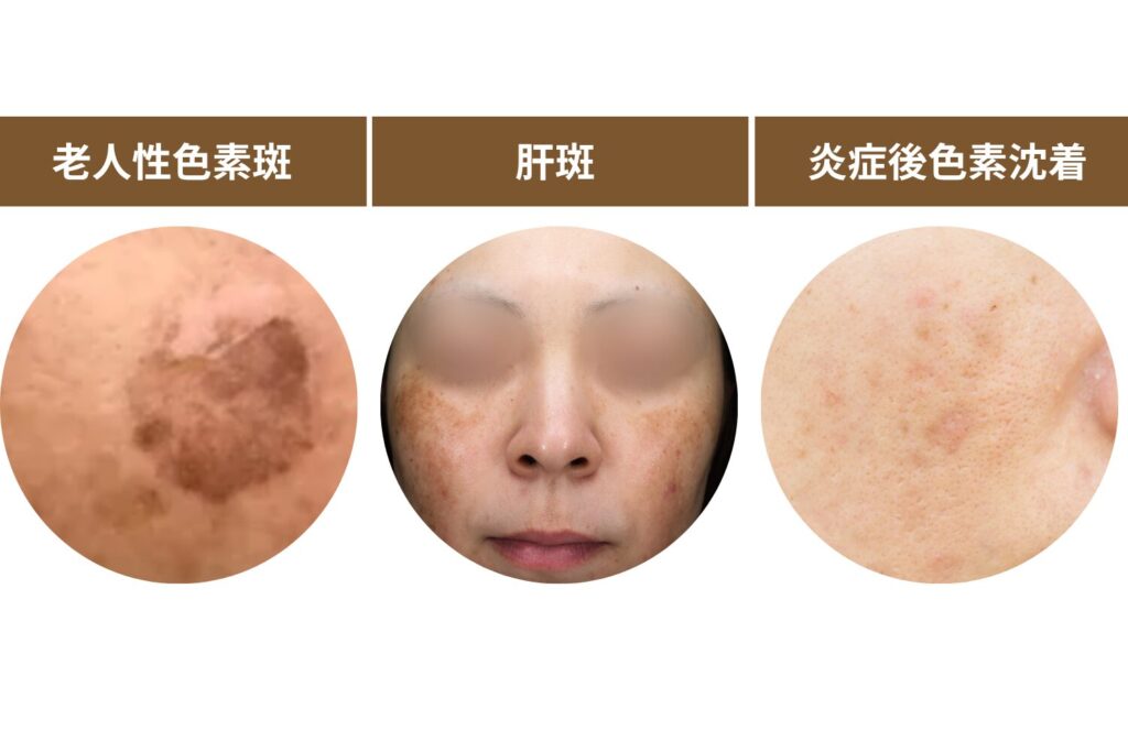 30代で目立つシミの種類と特徴を理解しよう