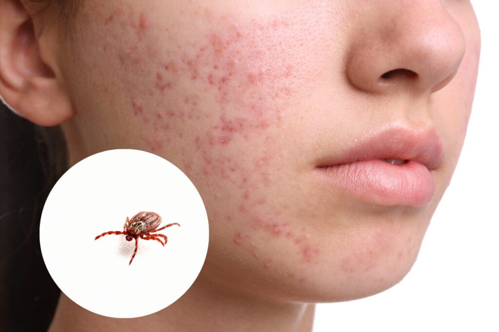ニキビダニとは？原因と見分け方、対策を完全網羅