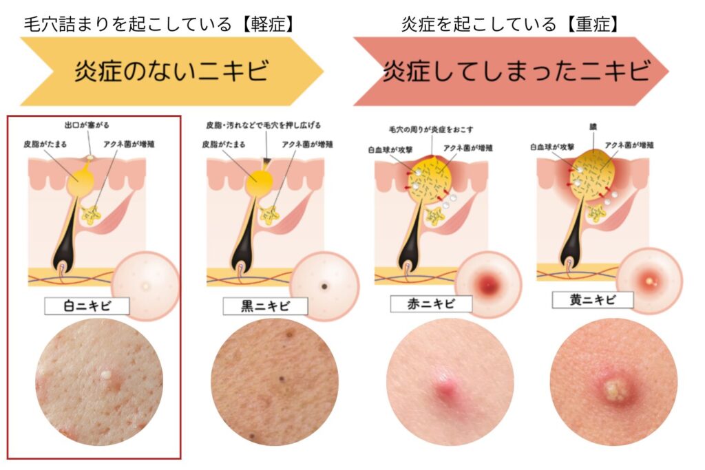 白いニキビは初期段階で治す