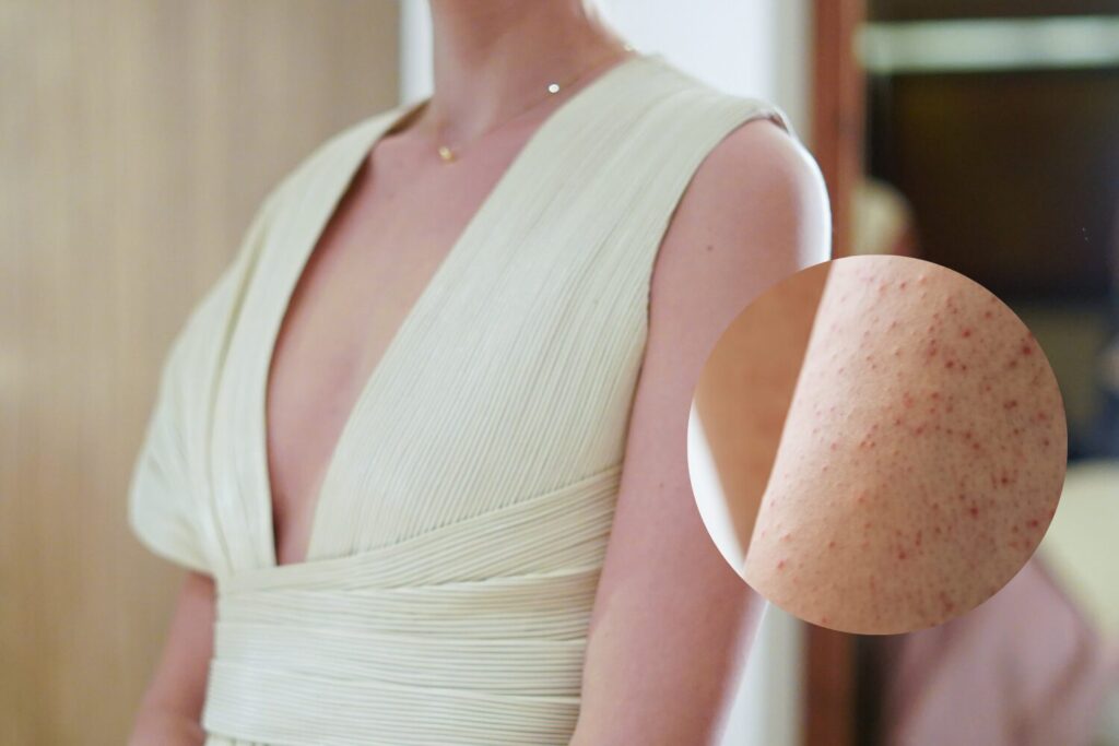 腕ニキビの原因と治し方|ブツブツ改善と予防法を徹底解説