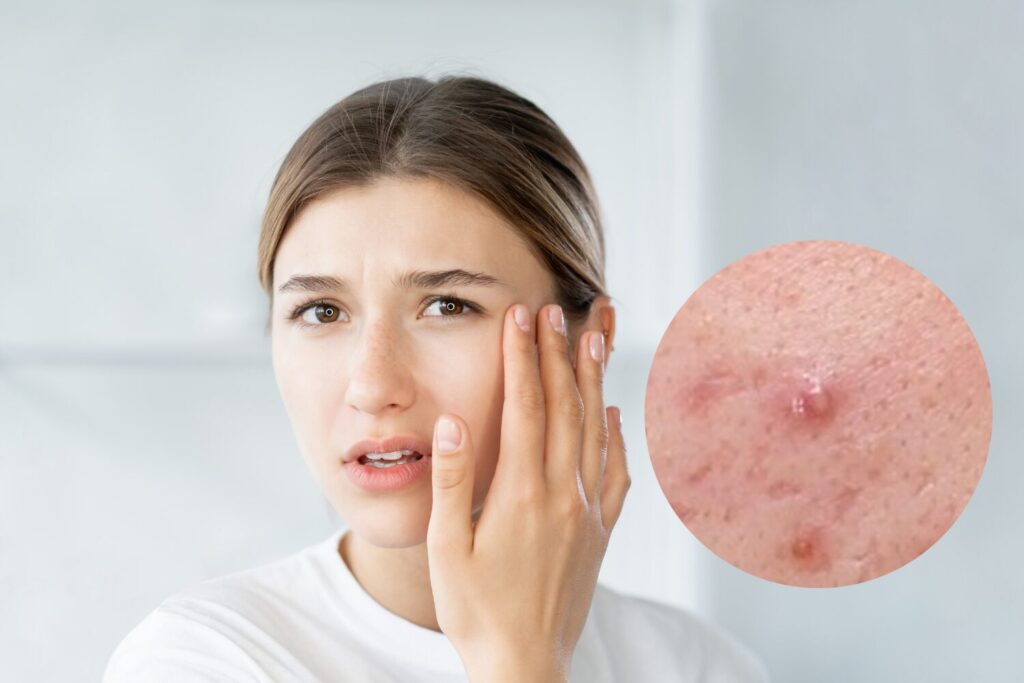 ニキビの芯の正体と安全な出し方|潰す前に知るべき原因と対処法