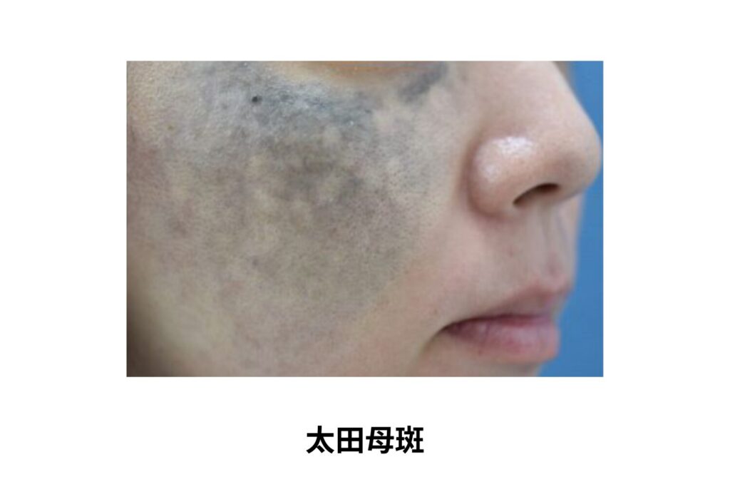 太田母斑