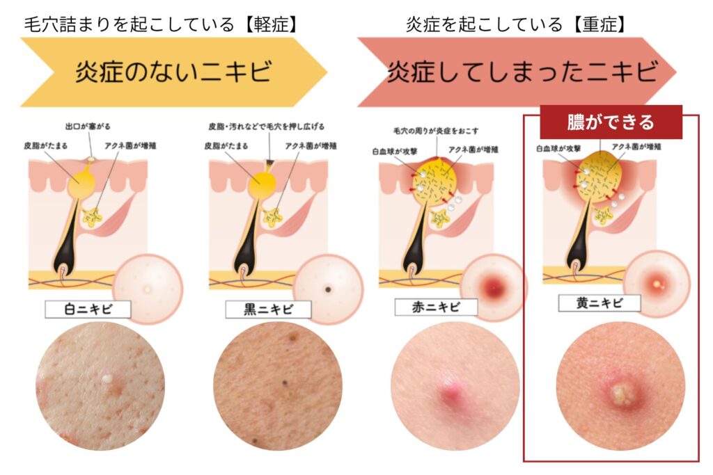赤ニキビから黄ニキビに進行