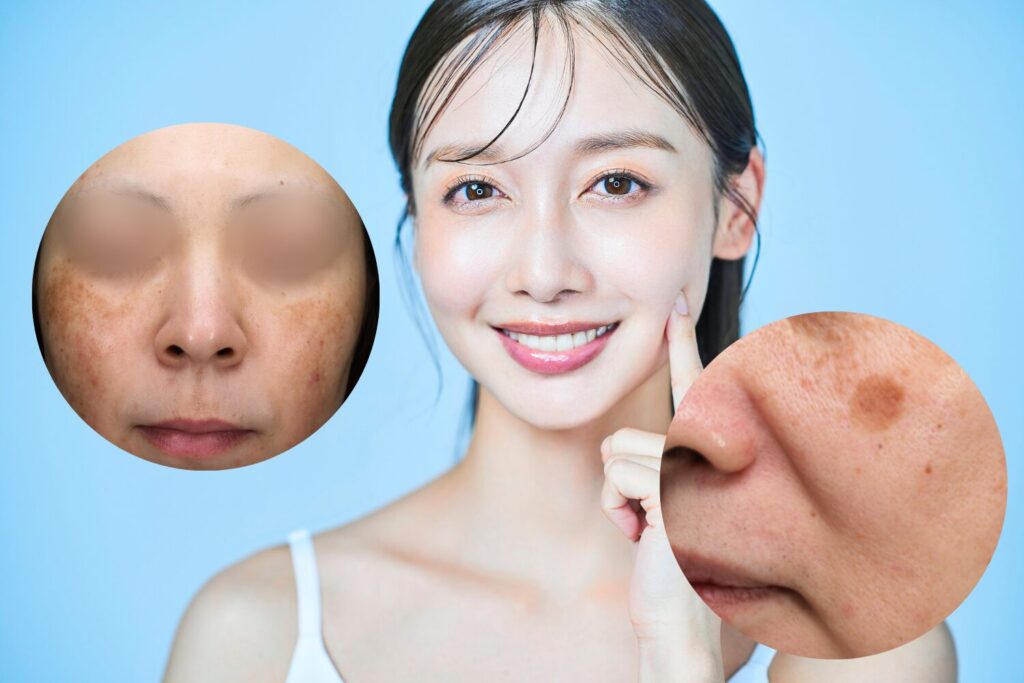 30代のシミはこうして防ぐ!原因と最新の改善法を徹底解説