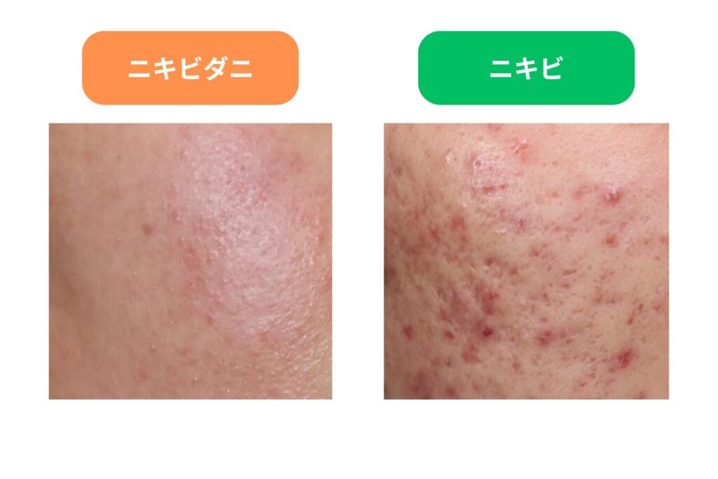ニキビダニが原因の症状を見分ける