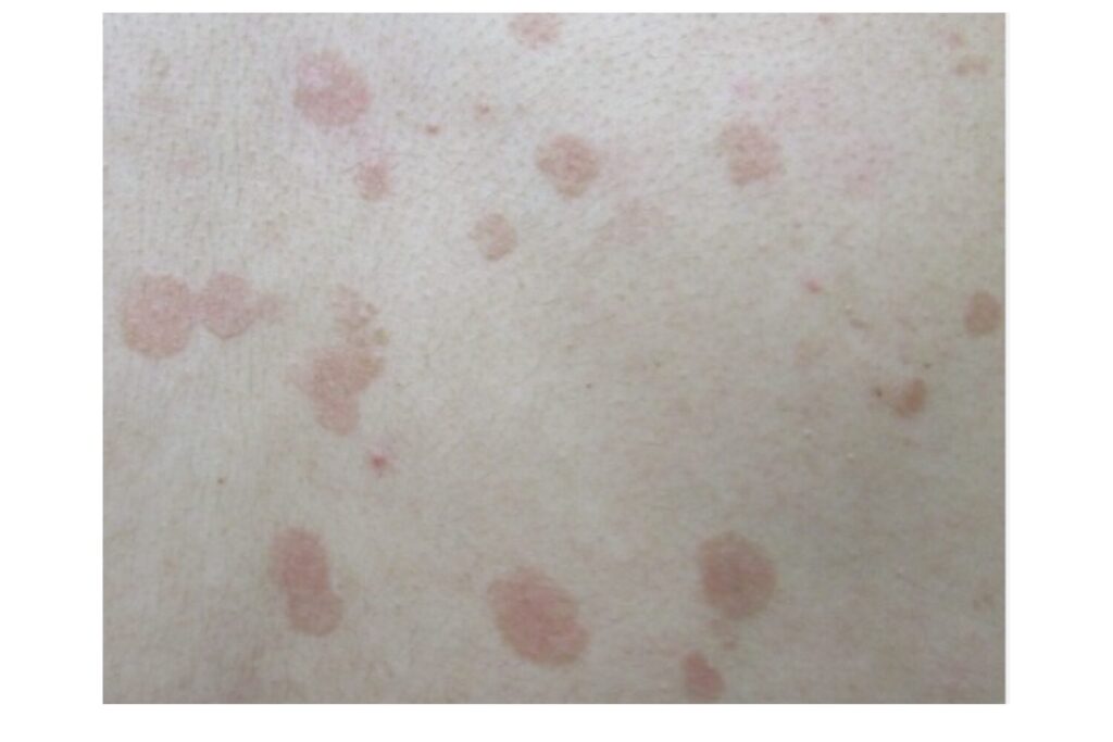 でんぷう（癜風）との違い