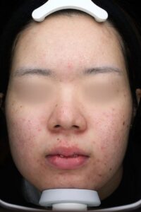 ニキビアフター