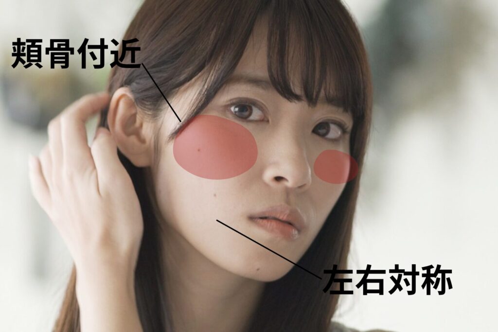 ADMができやすい部位