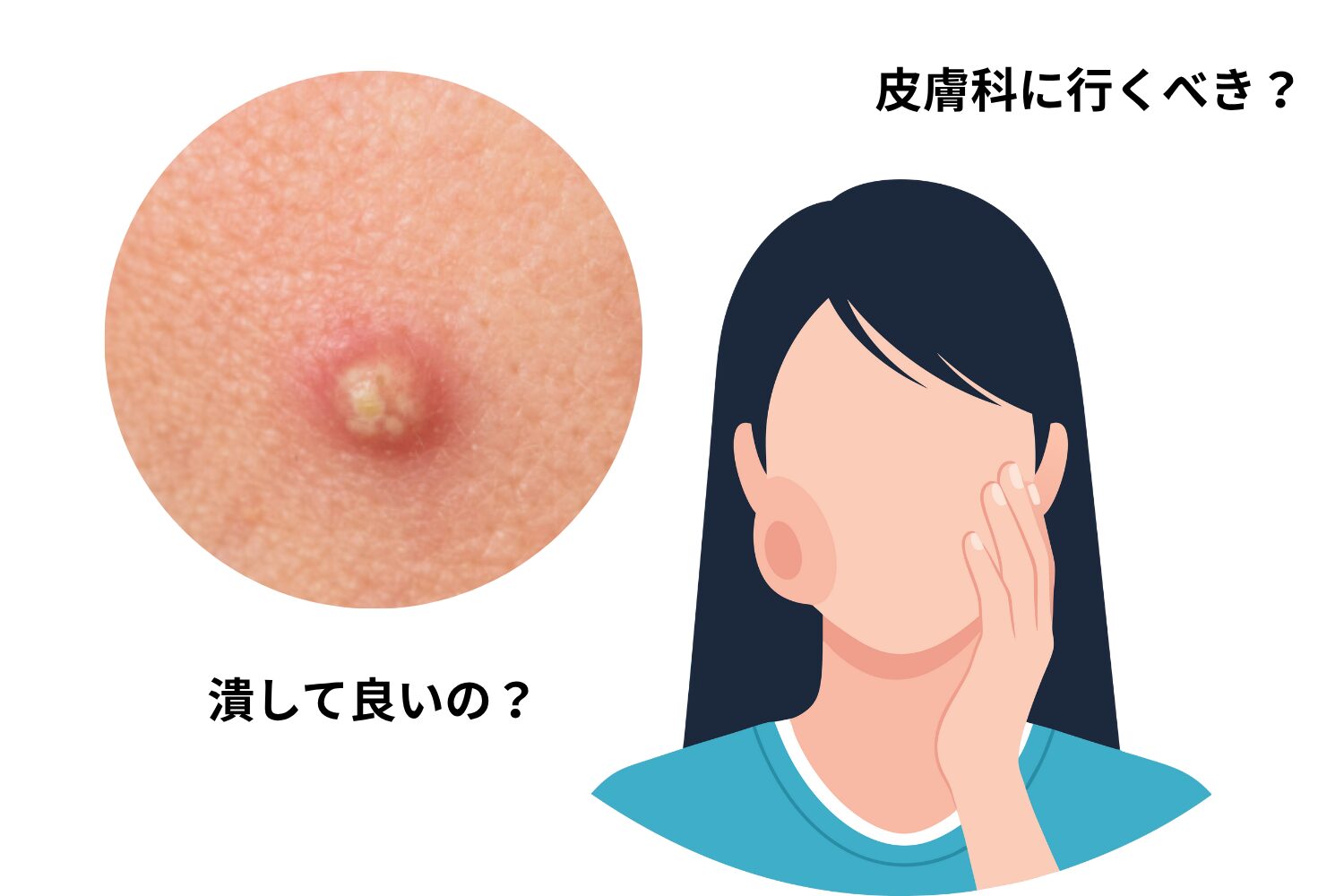 膿がパンパンのニキビ対処法|潰す前に知る原因と治し方