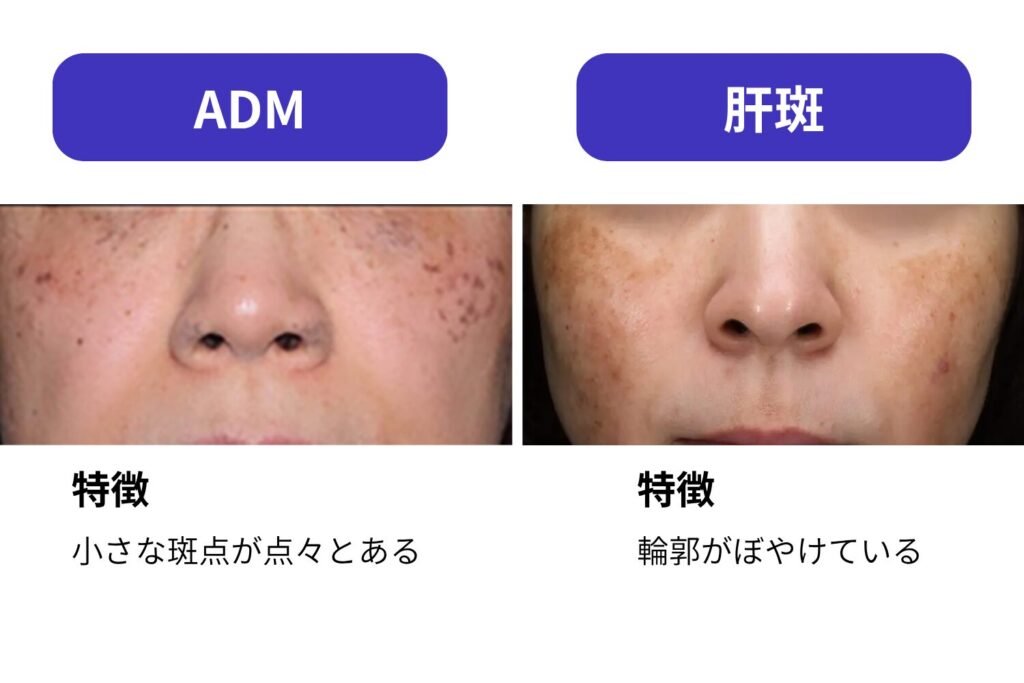 ADMと肝斑の違い