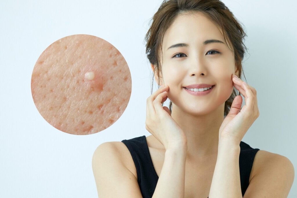 白いニキビは何が原因?正しいケア方法・早く治す習慣をまとめて...