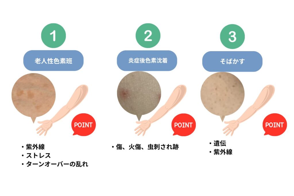 腕にできるシミの種類と見分け方