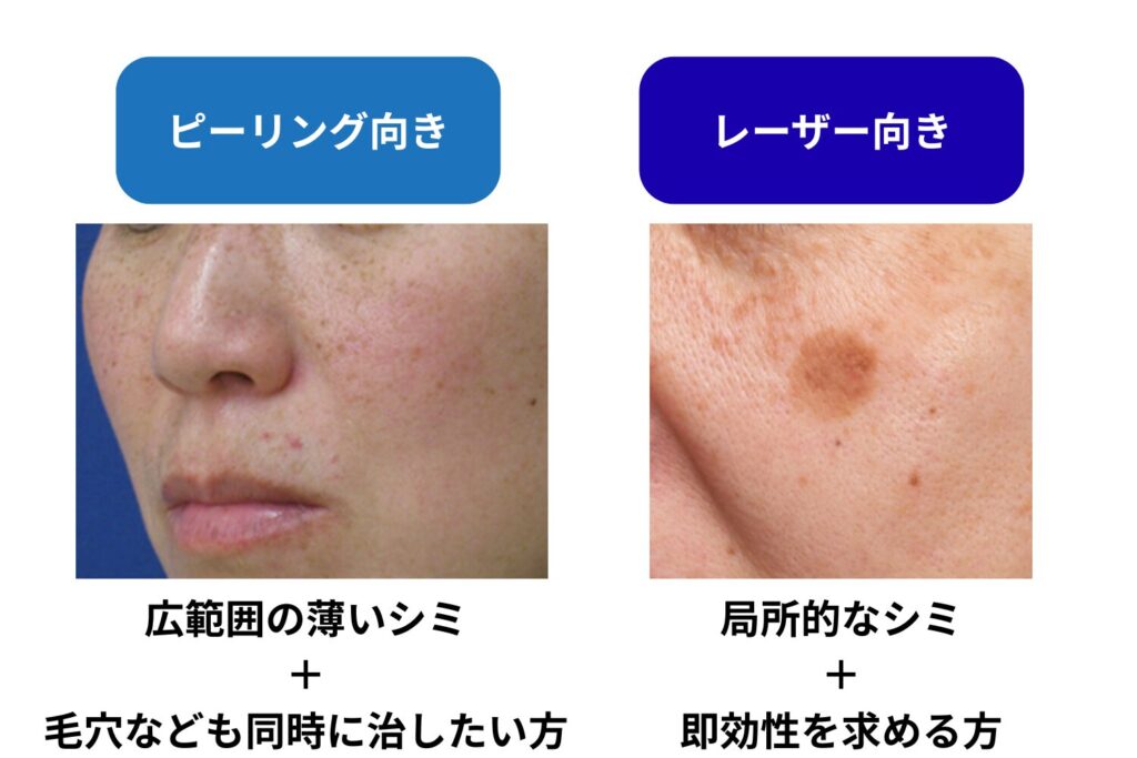 ピーリングが向く人とレーザーが向く人の違い