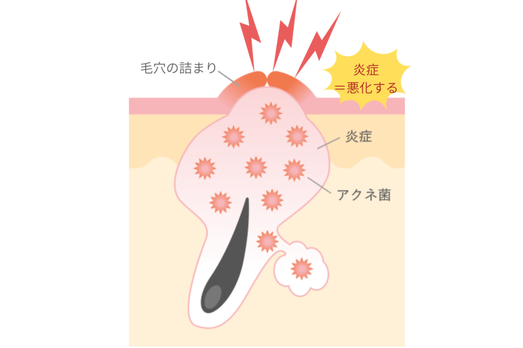 ニキビの芯が影響＝毛穴詰まりとアクネ菌の繁殖