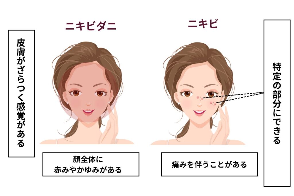 ニキビとの違い