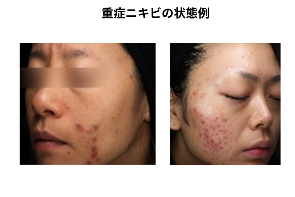 重症ニキビに使用される薬