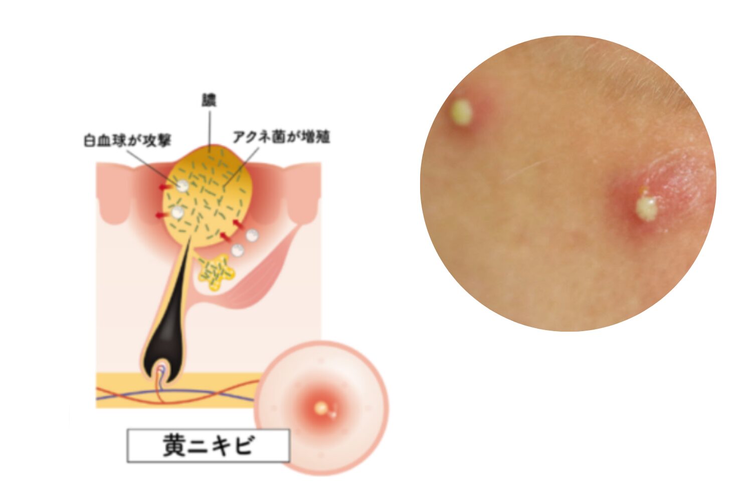 黄色ニキビの原因と治し方、悪化を防ぐ正しいケア方法を解説