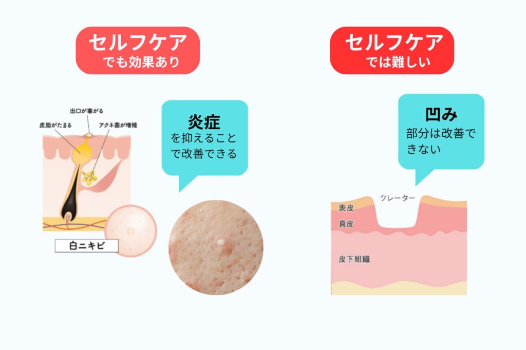 セルフケアが難しい理由