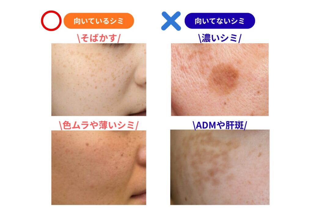 施術に向いているシミ